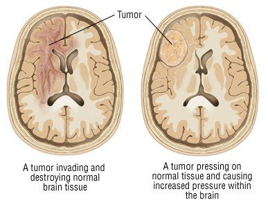 When possible, surgeons remove the tumor. Brain Tumor Guide: Causes, Symptoms and Treatment Options