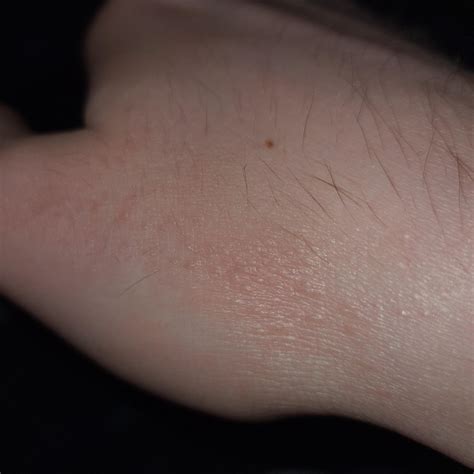 What Are These Bumps On My Hand Askdocs