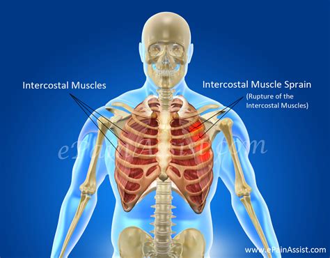 Intercostal Muscle Spraincausessymptomsdiagnosistreatment