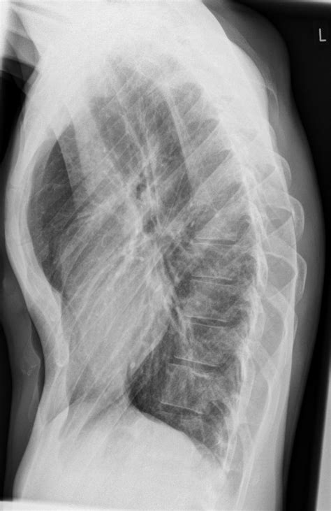 Cats aren't the only species that can have this problem, as humans and dogs can suffer from it as well. Funnel chest | Image | Radiopaedia.org