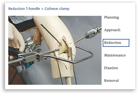 Education In Minimally Invasive Plate Osteosynthesis Mipo—how To