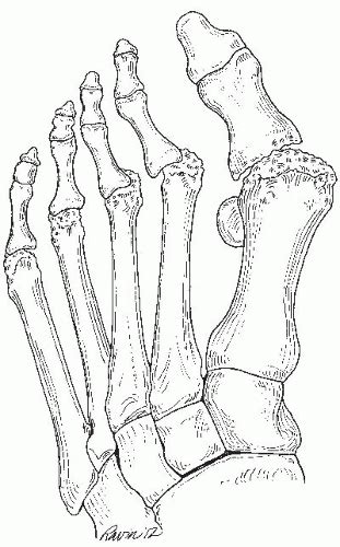 Rheumatoid Forefoot Reconstruction Musculoskeletal Key