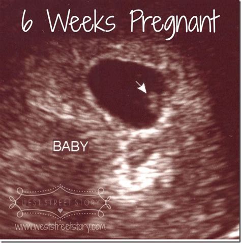 The 25 Best 6 Weeks Pregnant Ultrasound Ideas On Pinterest