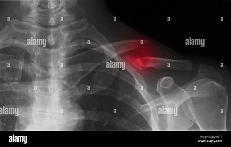 Collarbone X Ray Hi Res Stock Photography And Images Alamy