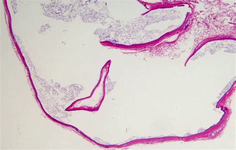Steatocystoma Multiplex Histology