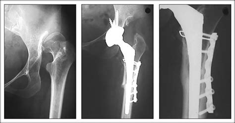 Figure 1 From An Oblique Osteotomy Is Better For Subtrochanteric