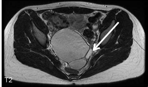 ovarian dermoid cyst mri radiologypics