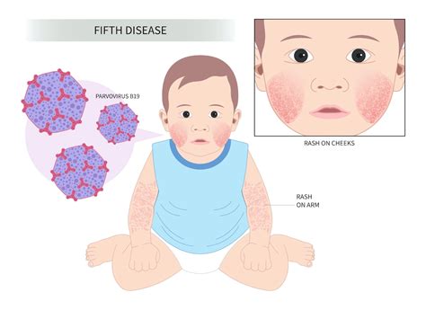 Fifth Disease In Children And Adults The Island News Beaufort Sc