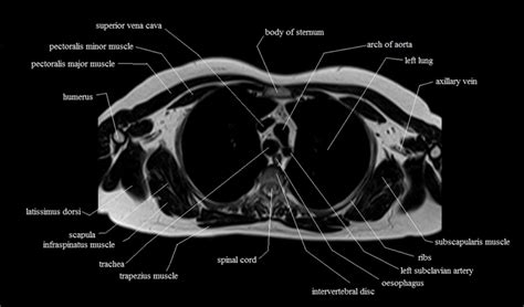 Mri of the upper limb. chest anatomy | MRI chest (thorax)axial anatomy | free cross sectional anatomy