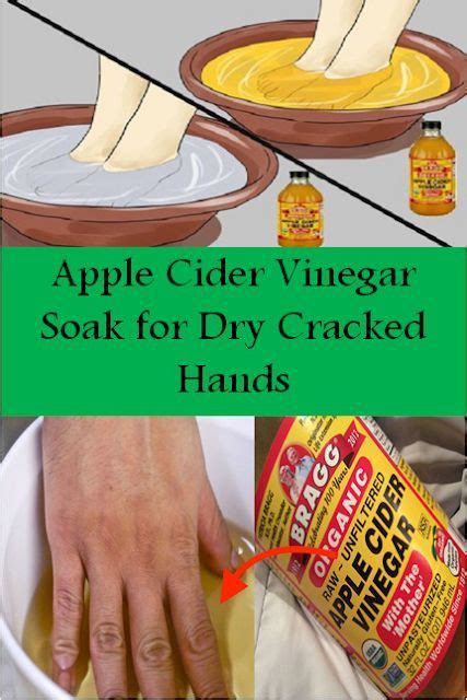 Apple Cider Vinegar Soak For Dry Cracked Hands Top 5 Diy Dry
