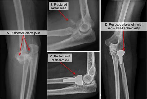 Elbow Dislocation Raleigh Hand Surgery — Joseph J Schreiber Md