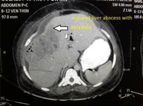 Ct Scan Coronal Section Showing Air In Liver Abscess With Peri Hepatic