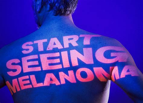 What Is Melanoma Start Seeing Melanoma