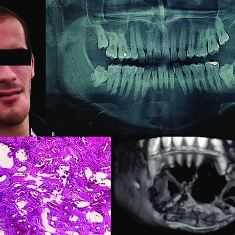 Pdf Aneurysmal Bone Cyst Of The Mandible With Conservative Surgical