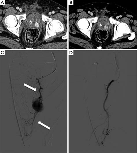 Arterial And Venous Phases Of The Ct Scan Revealed Pseudoaneurysm