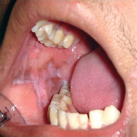 Clinical Photograph Showing Reticular Lichen Planus Of Right Buccal