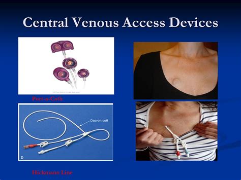 Central Venous Access Device Definition Central Venous Access Devices