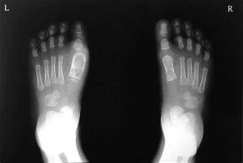 Skiagram Of Feet Showing Lytic Changes In Involved Bones Download Scientific Diagram