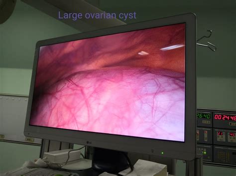 Ovarian Cyst Laparoscopy Is Treatment Of Choice Dr Ruchi Tandon