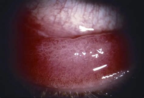 Papillary Conjunctivitis American Academy Of Ophthalmology