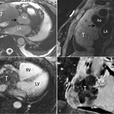 Ct Features Of A Malignant Peripheral Nerve Sheath Tumor In Right