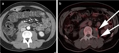 A 50 Year Old Male With Diagnosis Of Limited Follicular Lymphoma Fl