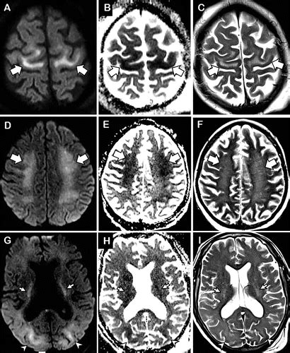 Covid 19associated Diffuse Leukoencephalopathy And Microhemorrhages