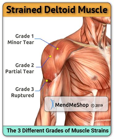 Torn Deltoid Ligament