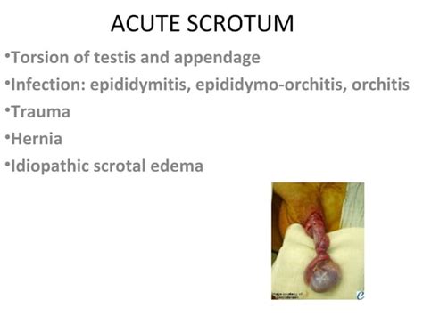 Acute Scrotum Ppt
