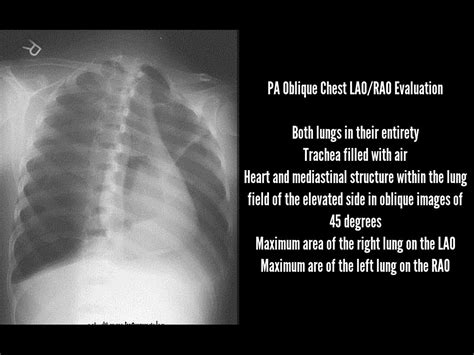Oblique View Chest X Ray