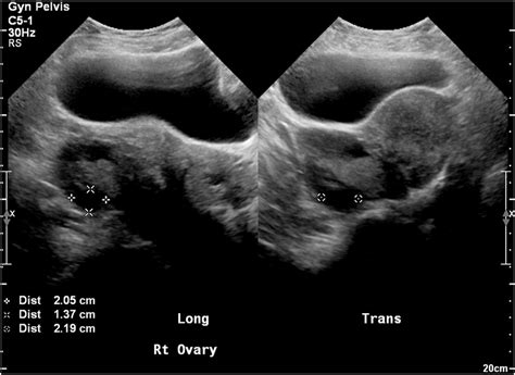 Preoperative Pelvic Ultrasound Right Ovary Download Scientific Diagram