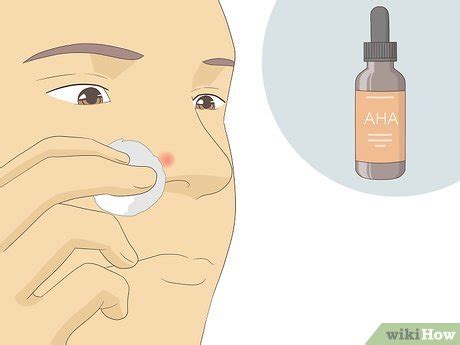 3 Ways to Get Rid of Acne Redness Fast - wikiHow