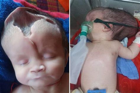 Baby Girl Born With Half Her Skull Missing Defies The Odds To Survive