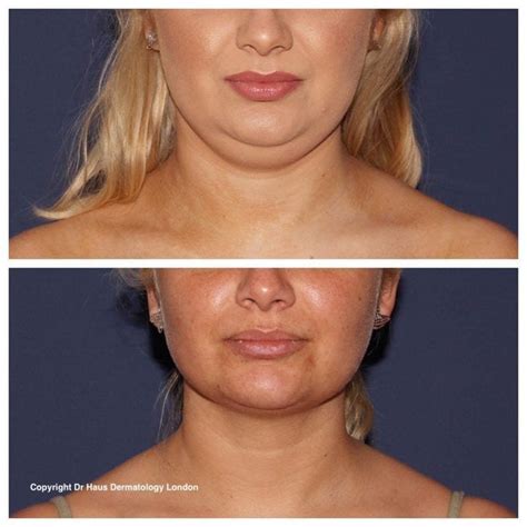 How To Remove A Double Chin Dr Haus Dermatology