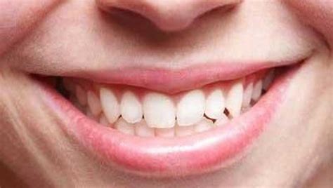 Pengalaman operasi cabut gigi geraham bungsu (impaksi gigi geraham bungsu / wisdom tooth) yang unik! Tips Saat Melakukan Cabut Gigi Geraham