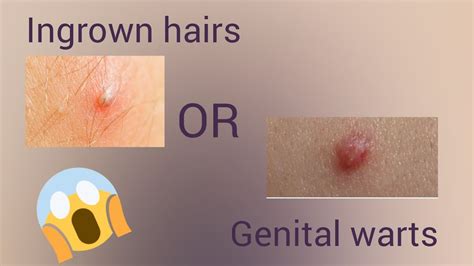 Genital Warts Or Ingrown Hairare Those Really Ingrown Hairs😱genital Wartshealth Youtube