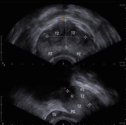 Prostate Anatomy Ultrasound