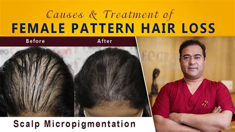 Top Image Female Hair Loss Treatment Thptnganamst Edu Vn
