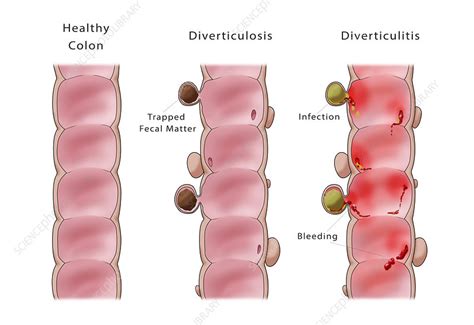 Comparison Of Diverticulosis And Diverticulitis Stock Image C