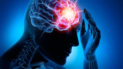 Epilepsie Ein Implantat Lässt Anfälle Vorhersagen