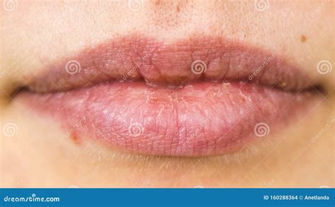 Female Dry Lips With Herpes Cold Sore Stock Photo Image Of Treatment