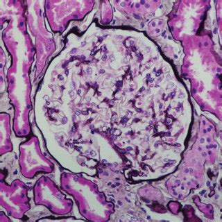 Check spelling or type a new query. (PDF) Isolate diffuse thickening of glomerular capillary ...