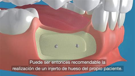 Injerto de hueso para implantes dentales Clínica Dental MiBO Almería