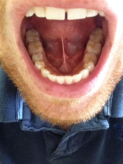 Small bumps located on top or sides of your tongue can give your i went to the doctor last thursday and he gave me a mouth wash. Bumps on floor of mouth. Thread discussing Bumps on floor ...