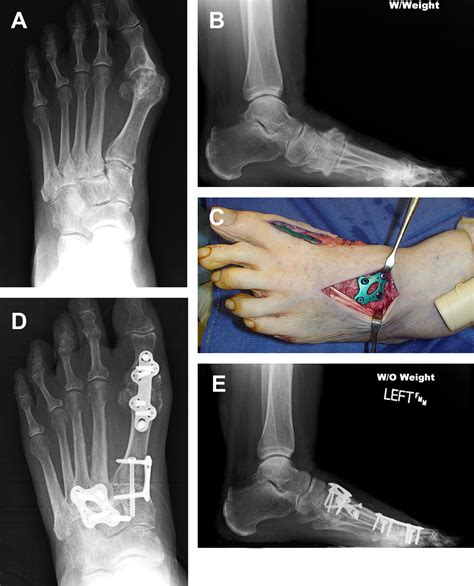 Surgical Correction Of Midfoot Arthritis With And Without Deformity