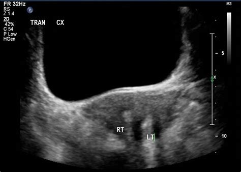 Uterine Didelphys Ultrasound