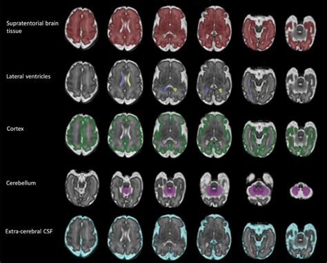 Normative Biometry Of The Fetal Brain Using Magnetic Resonance Imaging