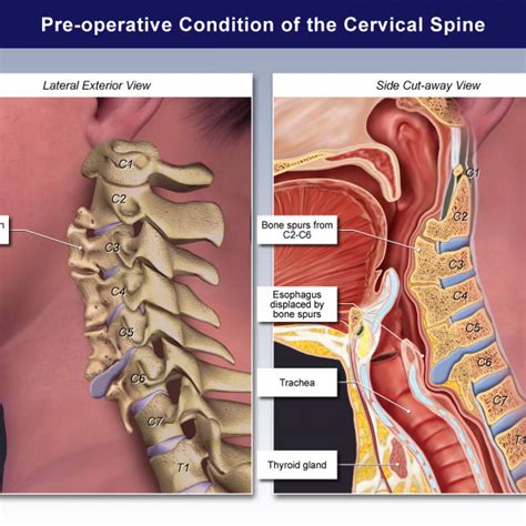 Pre Operative Condition Of The Cervical Spine Trialexhibits Inc