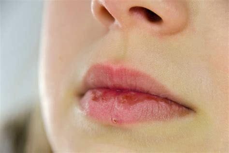 Bumps On Lips Small Little White Or Red Causes And Treatment American