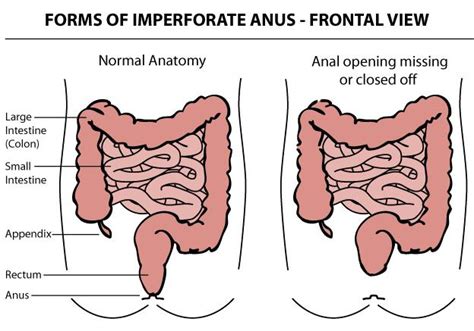 Imperforate Anus Nursing Management RNpedia